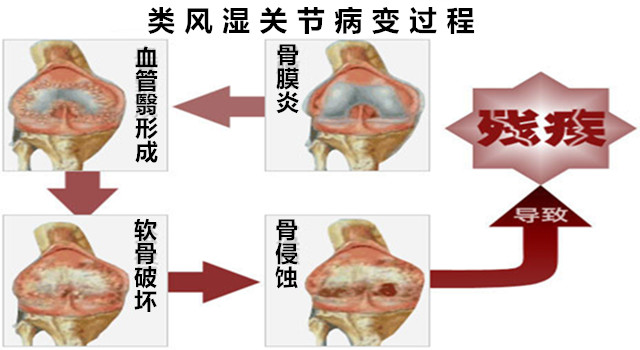 类风湿关节炎6.jpg