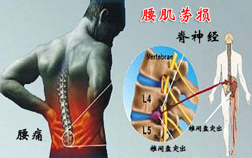 腰肌劳损的保健调理(作者:周远广)