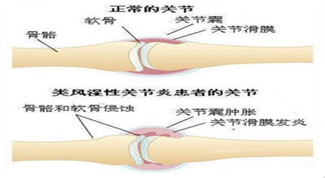 类风湿关节炎5.jpg