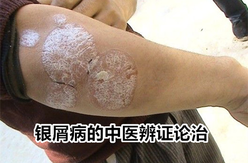 银屑病(牛皮癣)的辨证调理